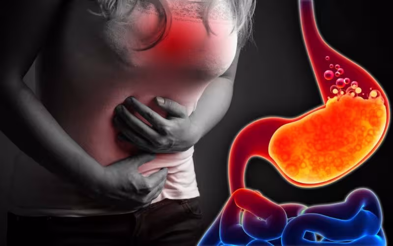 Comprehensive Approach to Acid Reflux & GERD Management